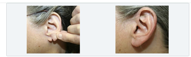 before and after earlobe repair